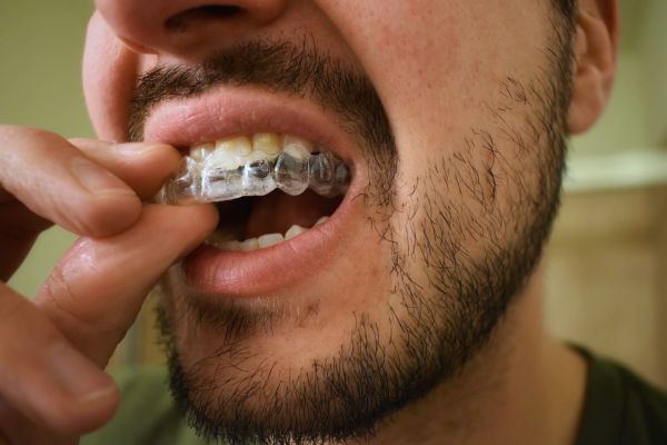 Man putting on invisible braces